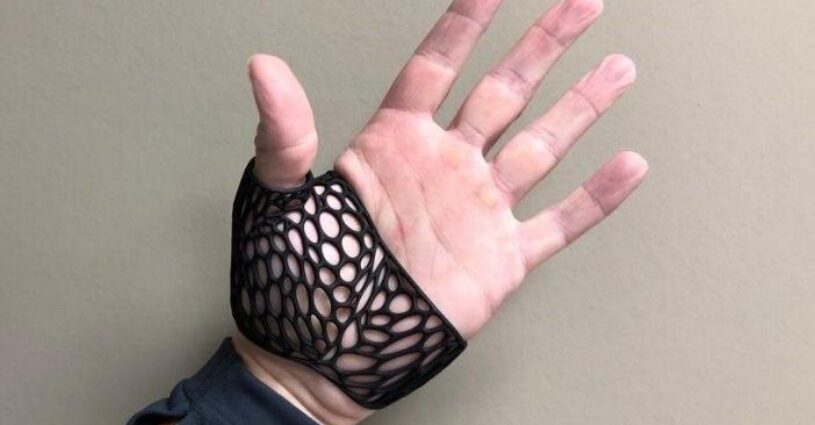 Xpert Handtherapie Brace Oceanz 3D Printing